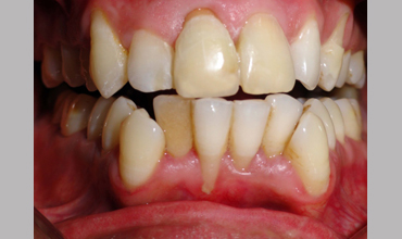 Veneerscrown and bridges treatment in Anand
                    